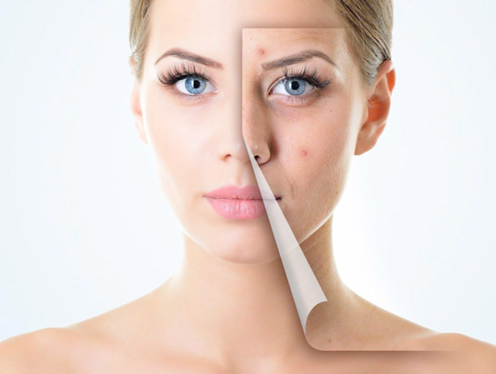image of woman with acne peeling away to reveal clear skin