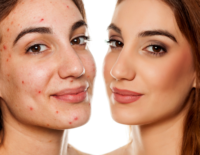Acne Treatment in Fort Collins, CO