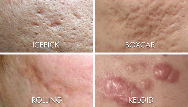 Types Of Acne Scars in Fort Collins & Loveland, CO