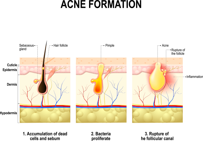 Acne Formation
