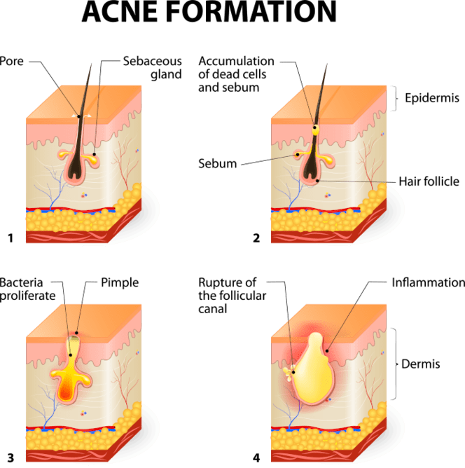 How Does Acne Form by Divine Dermatology Fc