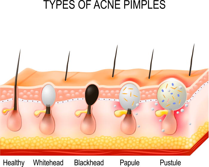 Types of Acne Pimples in Fort Collins & Loveland, CO