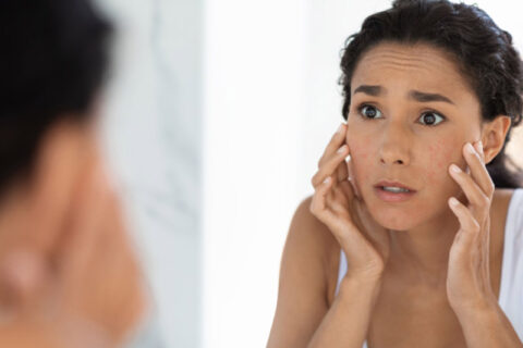 Skin products causing Acne in Fort Collins & Loveland, CO