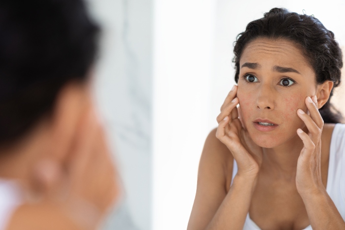 Skin products causing Acne in Fort Collins & Loveland, CO