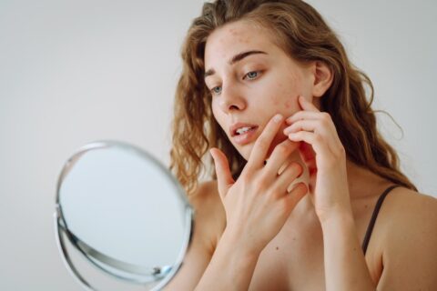 Dry, Flaky Acne Skin in Fort Collins & Loveland, CO