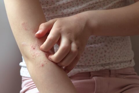 Preparation of Eczema in Fort Collins & Loveland, CO