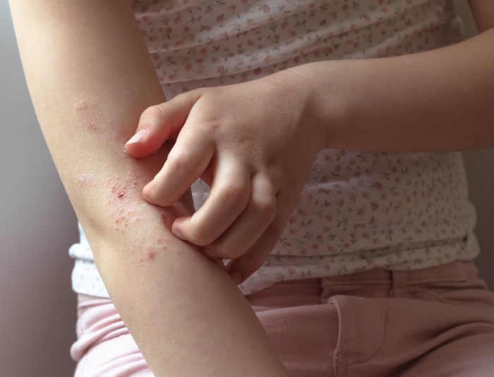 Preparation of Eczema in Fort Collins & Loveland, CO