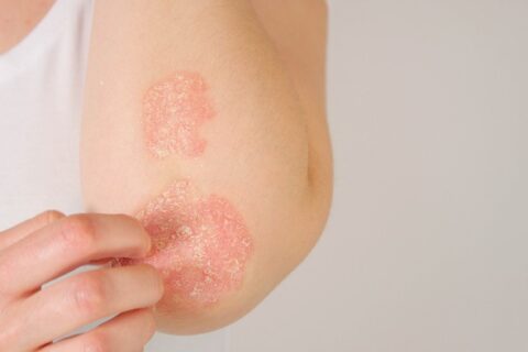 Symptoms of Psoriasis in Fort Collins & Loveland, CO