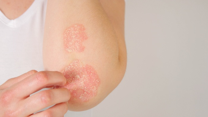 Symptoms of Psoriasis in Fort Collins & Loveland, CO