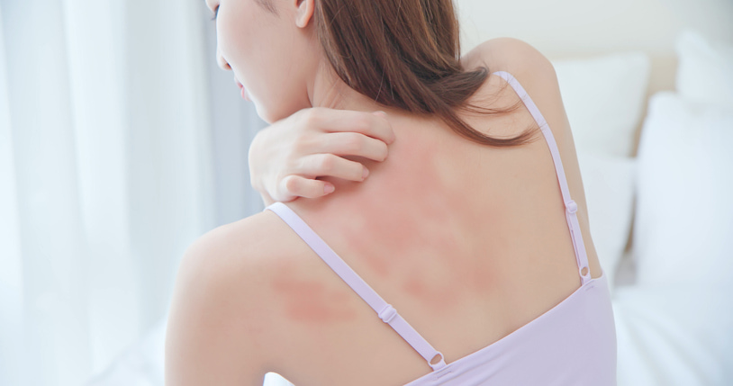 Drug rash symptoms and treatment in the dermatology clinic at Fort Collins and Loveland, CO