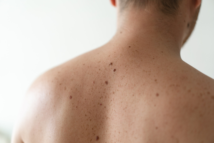 Skin mole evaluation and warning signs in the dermatology clinic at Fort Collins and Loveland, CO