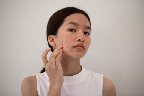 Adult Acne Treatments for Clearer Skin in Fort Collins & Loveland, CO