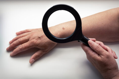 Understanding Early Signs of Skin Cancer Symptoms in Fort Collins & Loveland, CO