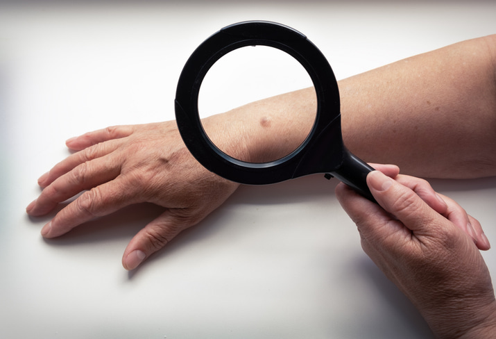 Understanding Early Signs of Skin Cancer Symptoms in Fort Collins & Loveland, CO