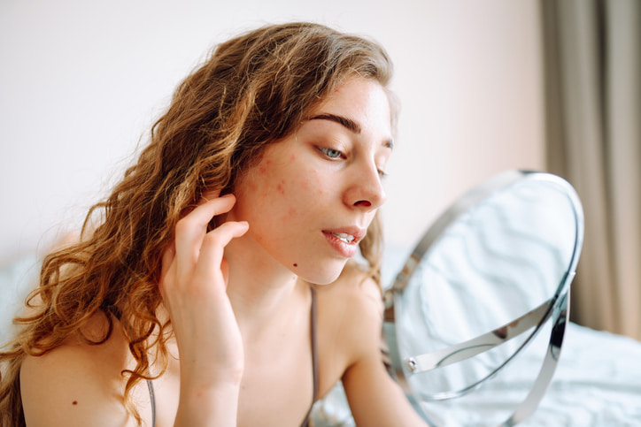 Clogged Pores Treatment in Fort Collins and Loveland, CO