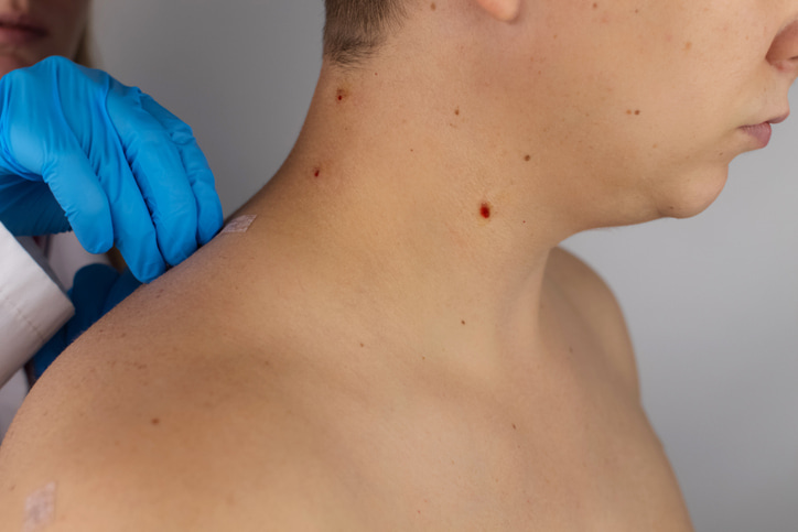Skin cancer excision procedures in Fort Collins and Loveland, CO