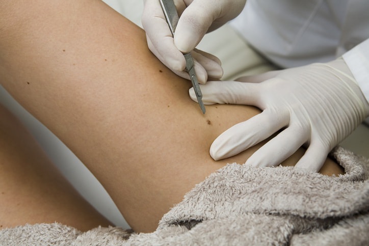 Mohs Surgery For Treating Skin Cancer in Fort Collins & Loveland, CO