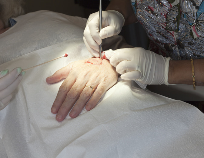 Process During Mohs Surgery in Fort Collins & Loveland, CO