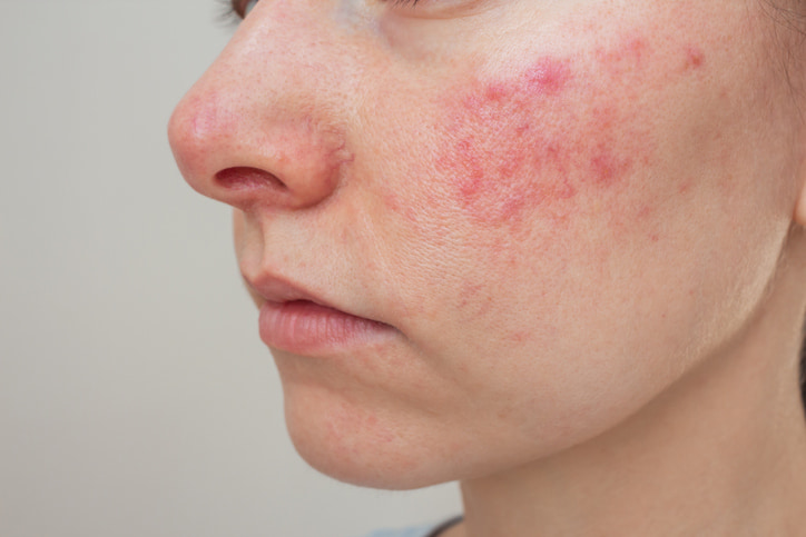 Patient undergoing evaluation for a common skin condition in Fort Collins & Loveland, CO