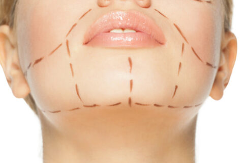 Patient undergoing Kybella cosmetic treatment in Fort Collins & Loveland, CO