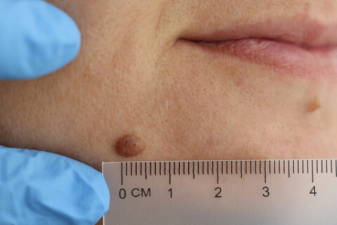 Understanding different skin growths in Fort Collins & Loveland, CO