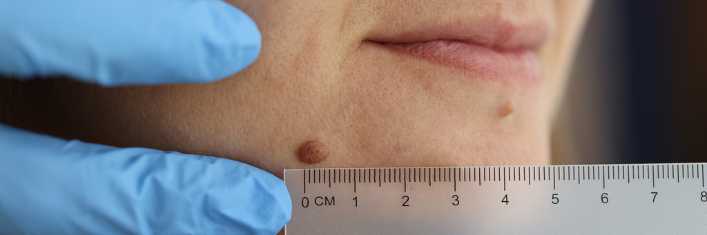 Understanding different skin growths in Fort Collins & Loveland, CO