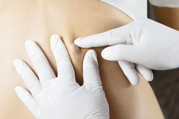 Cyst removal procedures