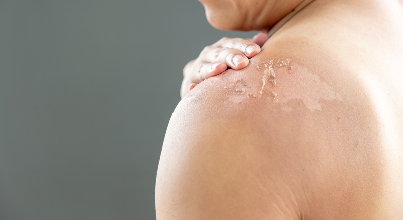 Sun damage treatment