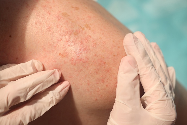 Close-up of red, inflamed skin on the shoulder during exam in Fort Collins & Loveland, CO